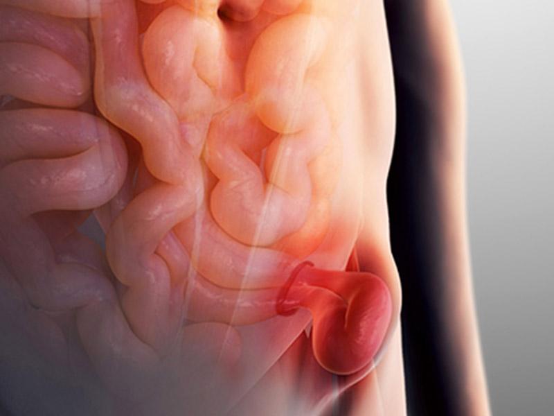 جراحی فتق چگونه انجام میشود؟ | درمان فتق با عمل جراحی در قزوین | دکتر نادر  خواجه شاهزانیان