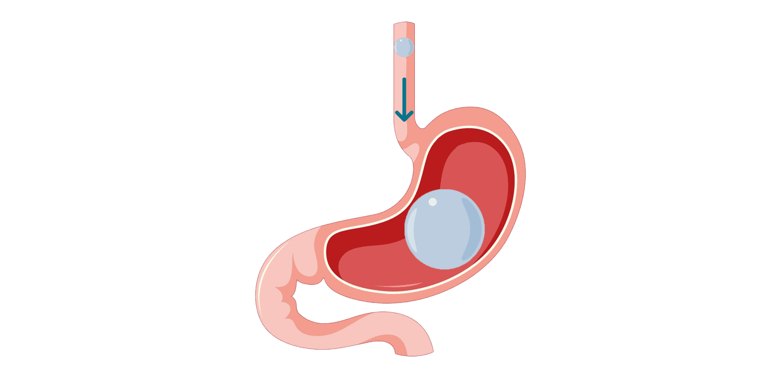 Endoscopic Gastric Balloon - iMed Medical